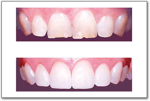 Teeth whitening before and after